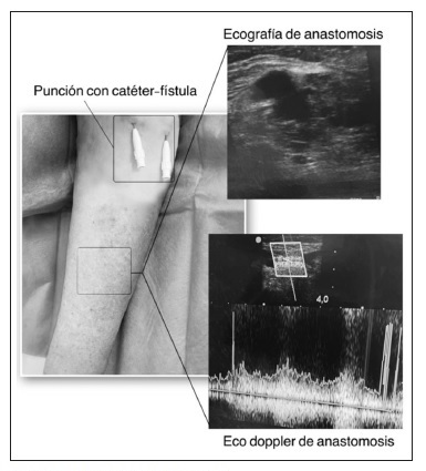 FAVe* radio-radial izquierda.
