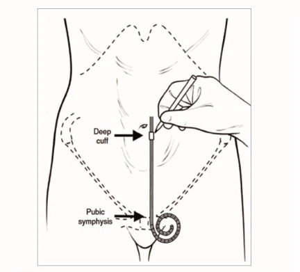 Ilustraci&oacute;n esquem&aacute;tica que indica la manera en que se selecciona el lugar de inserci&oacute;n del cat&eacute;ter y la ubicaci&oacute;n del cuff para lograr la posici&oacute;n p&eacute;lvica adecuada de la punta del cat&eacute;ter Crabtree JH. Selected best demonstrated practices in peritoneal dialysis access. Kidney Int Suppl. noviembre de 2006;(103):S27-37. figure9, Schematic drawing indicating the manner in which the catheter insertion site and deep cuff location are selected in order to achieve proper pelvic position of the coiled catheter tip; p. S34.
