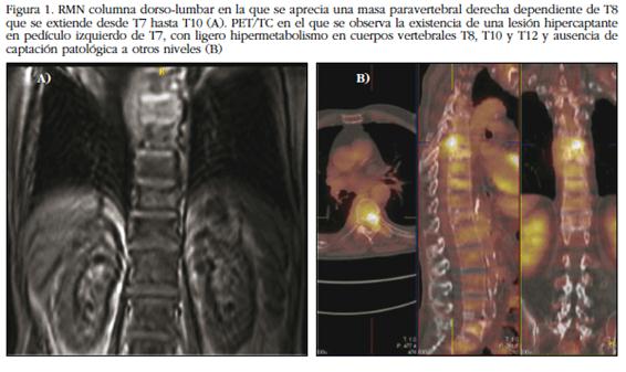RMN columna dorso-lumbar en la que se aprecia una masa paravertebral derecha dependiente de T8 que se extiende desde T7 hasta T10 (A). PET/TC en el que se observa la existencia de una lesión hipercaptante en pedículo izquierdo de T7, con ligero hipermetabolismo en cuerpos vertebrales T8, T10 y T12 y ausencia de captación patológica a otros niveles (B)
