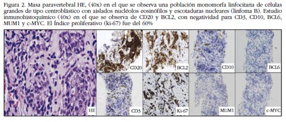 Masa paravertebral HE, (40x) en el que se observa una población monomorfa linfocitaria de células grandes de tipo centroblástico con aislados nucléolos eosinófilos y escotaduras nucleares (linfoma B). Estudio inmunohistoquímico (40x) en el que se observa de CD20 y BCL2, con negatividad para CD3, CD10, BCL6, MUM1 y c-MYC. El Índice proliferativo (ki-67) fue del 60%
