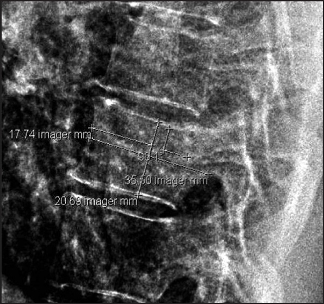 Figure. Vertebral parameters: It is observed that the length of the eigth dorsalvertebra (LVD8), from the horizontal one of his pedicle, taken at that height andparallel to the vertebral plate with superior disc contact, is 35,50 mm. Drawing a line perpendicular to the previous one (90,1º), and measured from the most sclerous area of the vertebral plate with disc contact superior to infeior, passing through the midpoint of its length (17,74 mm), we obtain a height of the eighth dorsal vertebra (HVD8) of 20,69 mm