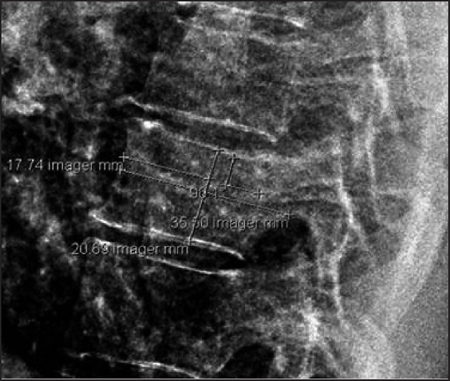 Vertebral parameters: It is observed that the length of the eigth dorsal vertebra (LVD8), from the horizontal one of his pedi-cle, taken at that height and parallel to the vertebral plate with superior disc contact, is 35,50 mm. Drawing a line perpendicular to the previous one (90,1°), and measured from the most sclerous area of the vertebral plate with disc contact superior to infeior, passing through the midpoint of its length (17,74 mm), we obtain a height of the eighth dorsal vertebra (HVD8) of 20,69 mm