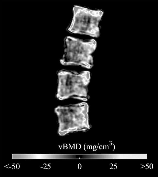 Differences between average vBMD of each group showed at the mid sagittal plane of the vertebral body