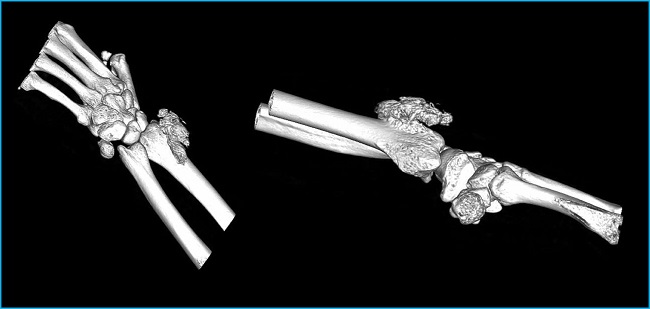 Reconstrucción en 3D de la TAC de muñeca izquierda