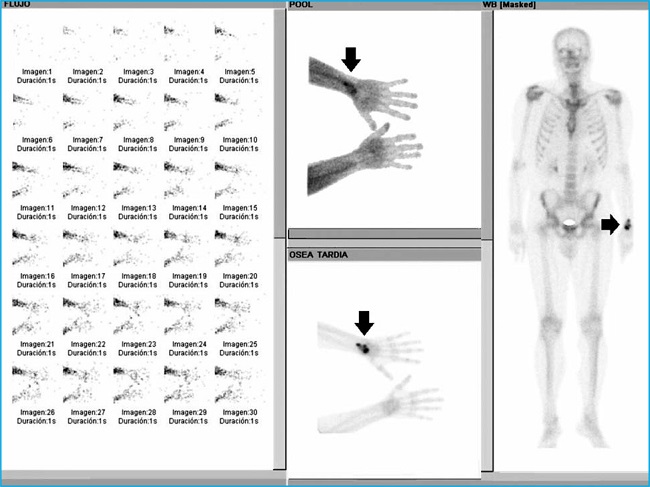 Gammagrafía ósea de tres fases de miembros superiores y tardía de cuerpo completo con Tc99m-difosfonatos