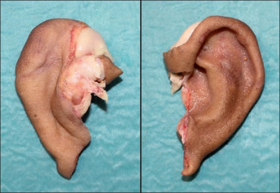 Amputación completa del pabellón auricular izquierdo como consecuencia de mordedura humana, incluyendo la raíz del hélix y la base de la concha auricular y respetando el origen del conducto auditivo externo y el lóbulo auricular. Vista posterior (izquierda) y anterior (derecha).