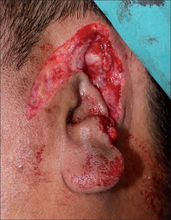 Preoperatorio del remanente auricular y de la zona receptora, con integridad del conducto auditivo externo.