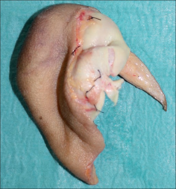 Detalle del marcaje intraoperatorio del segmento amputado. El nudo de seda 4/0 en la zona inferior de la base de la concha auricular se corresponde con una rama arterial. El resto de nudos identifican ramas venosas, siendo las más favorables las 2 situadas en la zona superior del hélix.