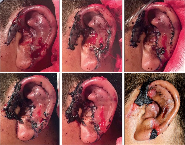 Postoperatorio de la evolución del reimplante auricular. De izquierda a derecha y de arriba abajo: 1º, 2º, 3º, 4º, 5º y 16º días de postoperatorio. A destacar la evolución del aspecto congestivo del reimplante y la delimitación de 2 escaras necróticas en las zonas más distales del reimplante.