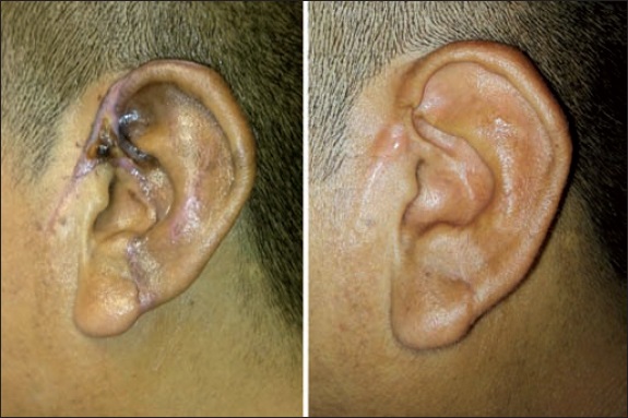 Aspecto del pabellón auricular reimplantado al alta definitiva a los 40 días de postoperatorio (izquierda) y al año de seguimiento (derecha). Destacan su excelente resultado estético y la restitución completa del segmento amputado, así como la ausencia de cicatrización patológica y de reabsorción del cartílago auricular.