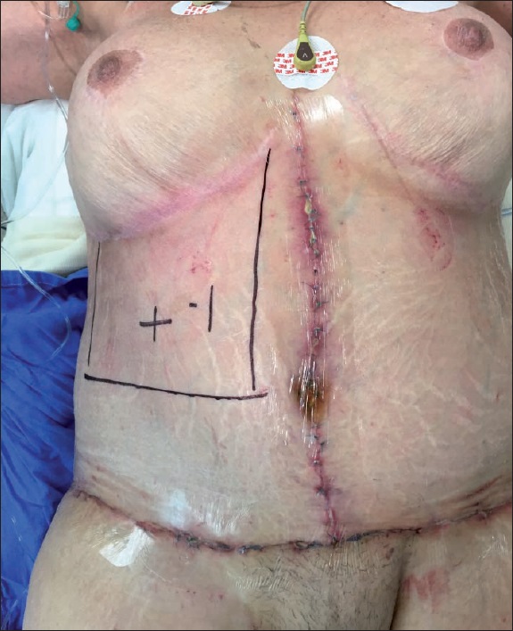 Planificación quirúrgica para exteriorización de ileostomía en sitio no vulnerable.