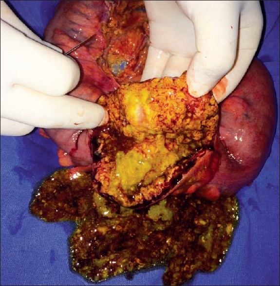 Pieza enviada a Patología. Se observan pseudomembranas, a modo de placas blanquecinas adheridas a la pared intestinal.
