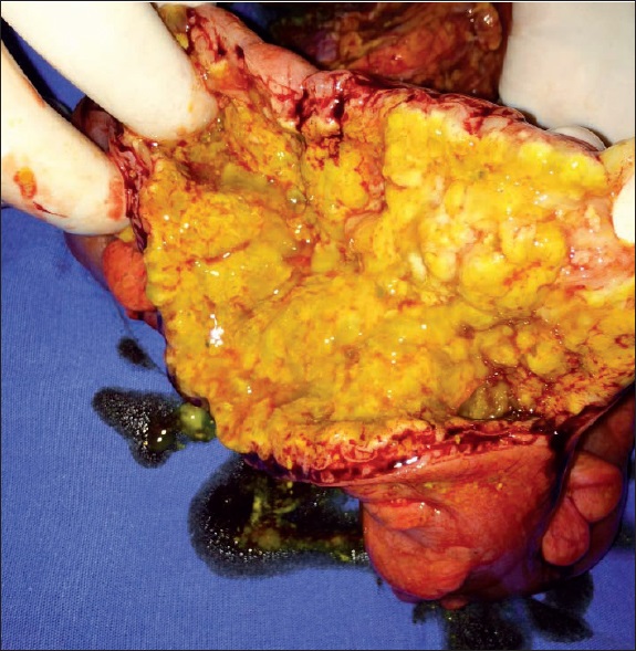 Acercamiento de imagen de la pieza de resección.