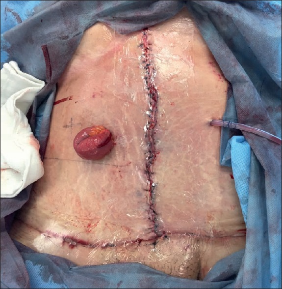 Postoperatorio inmediato. Maduración de ileostomía en sitio no vulnerable y drenaje cerrado subcostal izquierdo dirigido a cavidad intrabdominal.