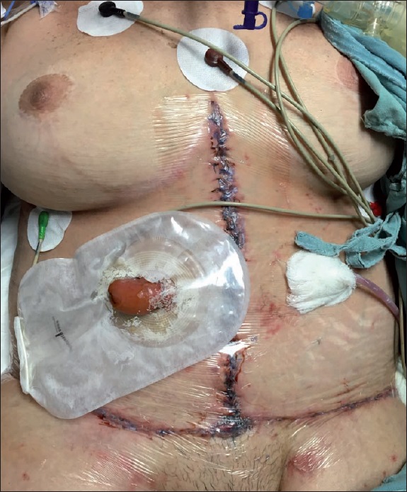 Postoperatorio inmediato. Ileostomía funcional y aislamiento de heridas con Tegaderm® para evitar su contaminación con material intestinal.