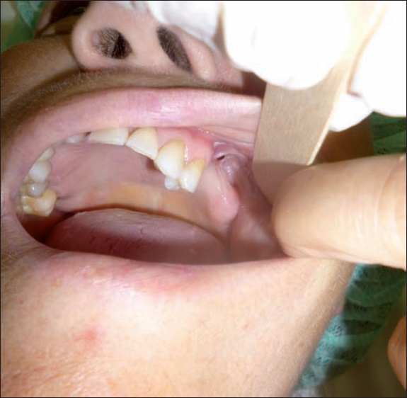 Fístula oroantral del 2º cuadranrte. Fístula oroantral do 2º quadrante