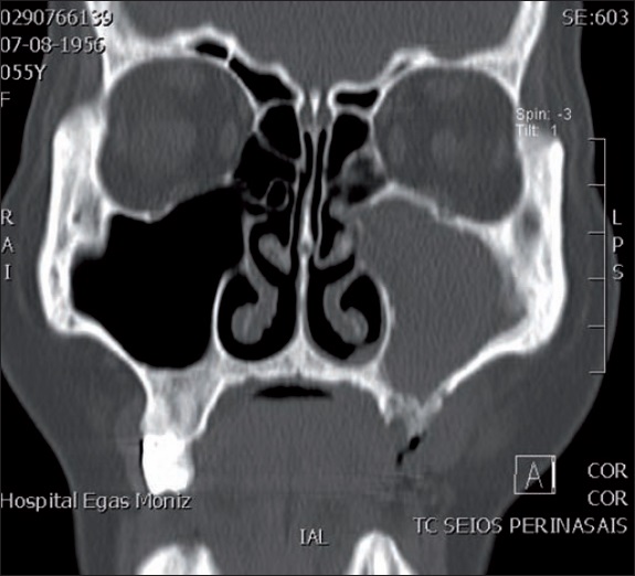 Tomografia axial computarizada: rarefacción ósea alveolar. Tomografia axial computorizada – rarefacção óssea alveolar
