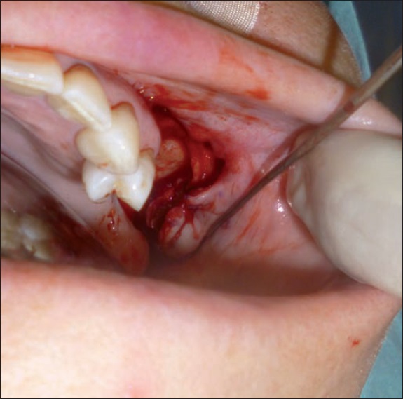 Colgajo mucoperióstico vestibular de avanze. Retalho mucoperiósseo vestibular de avanço