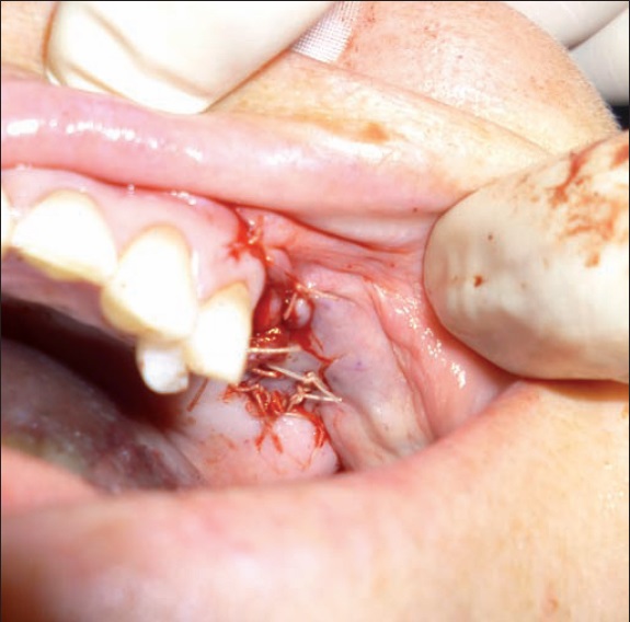 Cierre sin tensión. Encerramento sem tensão