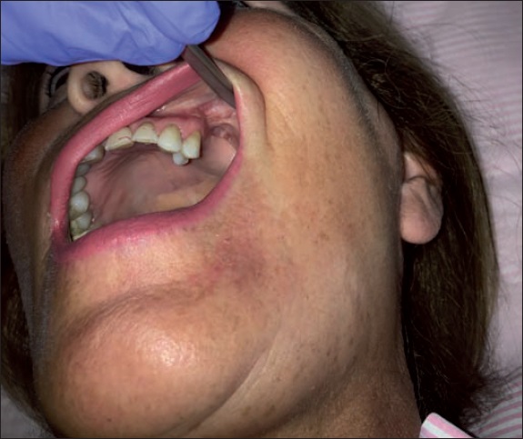 Postoperatorio a los 6 meses. Pós-operatório aos 6 meses.