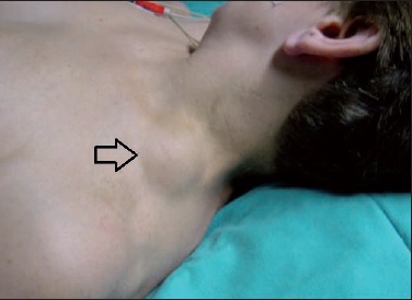 Flecha: schwannoma de gran tamaño (caso 1) dependiente de raíz C6. Masa supraclavicular no indurada y poco móvil que genera hipoestesia en el dermatoma correspondiente. Signo de Tinel positivo, sin bloqueo del potencial nervioso pese a su gran tamaño. Diagnosticado como lipoma gigante y derivado para extirpación o biopsia. Remitido sin pruebas complementarias. Electromiografía y resonancia magnética solicitadas por Cirugía Plástica.