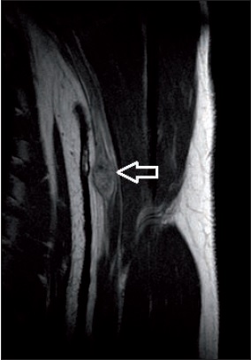 Resonancia magnética de extremidad superior (caso 3): tumoración (flecha blanca) que respeta los axones del nervio compatible con schwannoma. Derivado con diagnóstico de posible tumoración de origen nervioso. La ecografía informaba del tamaño aproximado de la tumoración y sugería, pero no confirmaba, el origen de la misma.