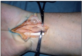 Exéresis de schwannoma en muñeca derecha dependiente del nervio mediano; se respeta la integridad de los fascículos sanos (caso 9). La tumoración no producía clínica ni repercusión alguna en la vida del paciente. Solo se veía y palpaba. Signo de Tinel positivo. La resonancia magnética evidenció la relación intraneural en el nervio mediano.