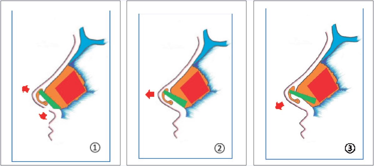 Injertos de extensión septal caudal (Toriumi). Según su forma y orientación, el injerto produce diferentes efectos en la punta y la columela: 1.- Proyecta la punta y corrige la retracción columelar. 2.- Proyecta y rota la punta. 3.- Disminuye la rotación de la punta.