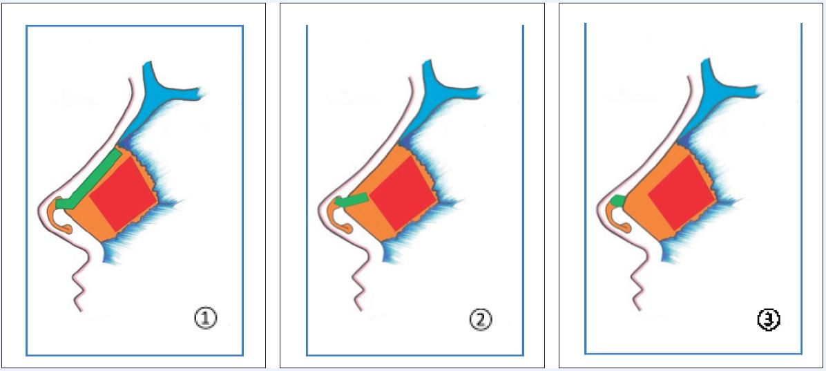 
                        Injertos de extensión septal dorsal (Byrd). 1.- Tipo injerto de extensión emparejado (
                        paired sprea-der type
                        ). 2.- Tipo listón emparejado (
                        paired batten type
                        ). 3.- Tipo extensión septal directa (
                        direct septal extension type
                        ).
                    