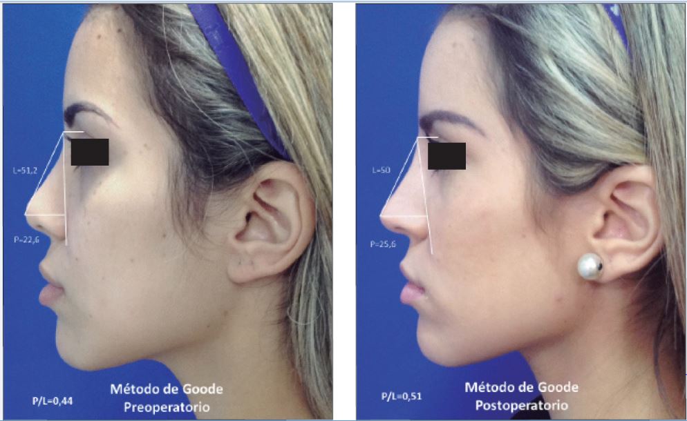 Métodos de Goode. La proyección nasal corresponde a la distancia entre la punta y una línea que une el ala nasal con el radix.