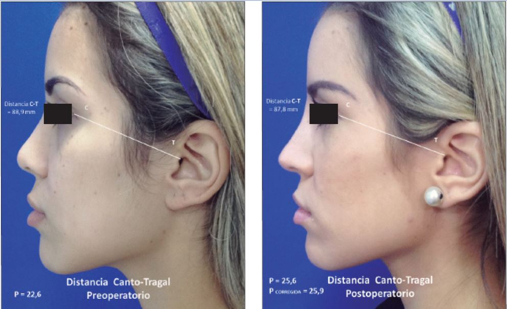 Factor de Corrección. Coeficiente canto/tragal. Se obtiene dividiendo la distancia entre el canto externo y el trago en la fotografía postoperatoria y en la preoperatoria.