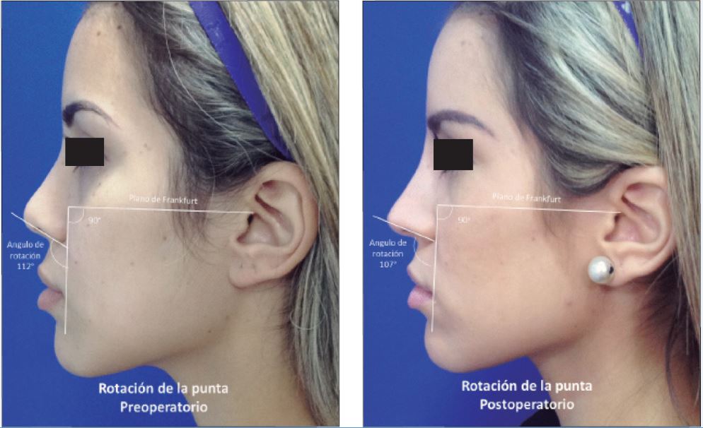 Ángulo de rotación de la punta. Se mide entre el plano facial y el eje mayor de los orificios nasales.