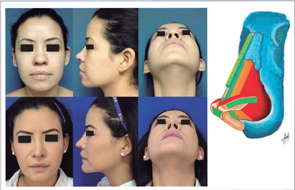 Rinoplastia primaria. Punta bulbosa, septodesviación caudal, orificios asimétricos, dorso y radix bajos. Rinoseptoplastia más toma de material para injerto del septum (marco en L de 10 mm). Rinoplastia estética: resección de tejido fibro-adiposo de la punta, injerto extensor septal caudal (IECS) término-terminal, injertos de expansión septal extendidos, injerto de dorso (lámina de polietileno poroso más cartílago autólogo más tejido fibro-adiposo de la punta), resección de la porción cefálica de los cartílagos alares más injertos de varas alares, puntos inter e intradomales más injerto en punta en escudo. Mentoplastia con prótesis de polietileno poroso (abordaje vestibular). Postoperatorio a los 3 años