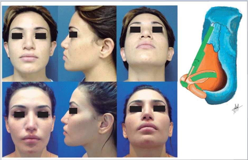 Paciente con antecedente de dos rinoplastias abiertas. Punta bulbosa mal definida con columela corta y nariz ancha. Toma de injerto de 5° arco costal derecho. Rinoplastia estética: injertos de extensor septal caudal más injerto de dorso más varas alares más punta (injerto tipo escudo más injerto en sombrero). Otoplastia. En un segundo tiempo se realizó liposucción de bolsas de Bichat. Postoperatorio a los 2 años.