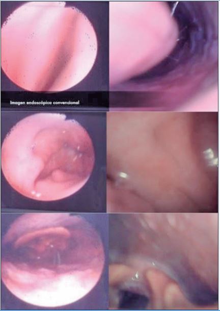 Imágenes obtenidas con endoscopia convencional (Izda.) frente a imágenes obtenidas con nasolaringofibroscopio portátil (drcha.).