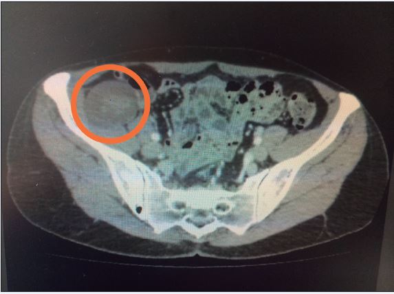 Masa retroperitoneal en fosa iliaca derecha de 5 x 3.5 x 3 cm de diámetro en contacto con músculo psoas.