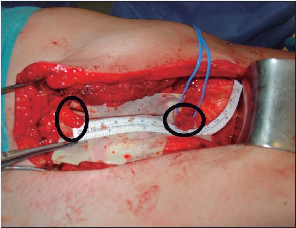 Localización de los 2 cabos del nervio femoral en el defecto creado tras la resección de la masa tumoral.