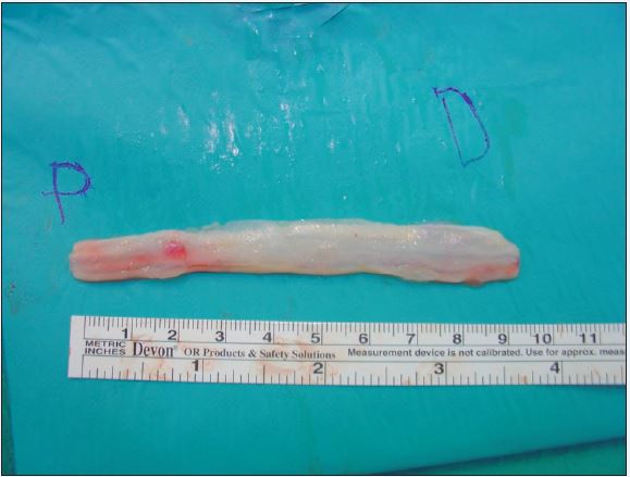 Injerto nervioso de sural con 4 cables.