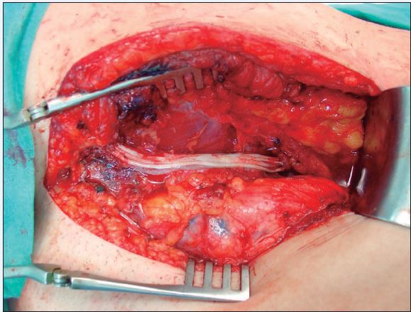 Injerto interpuesto.