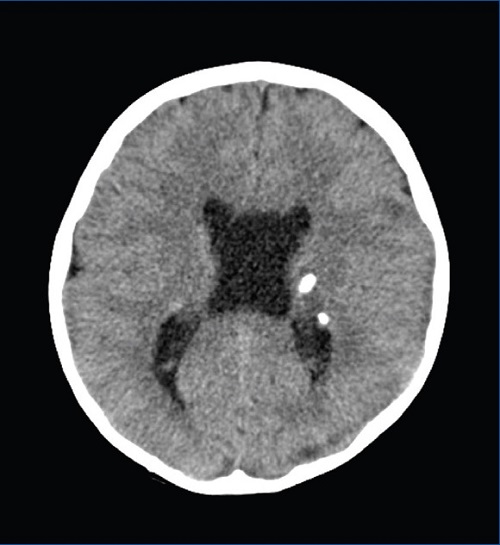 TC craneal (corte axial): lesiones parenquimatosas calcificadas periventriculares