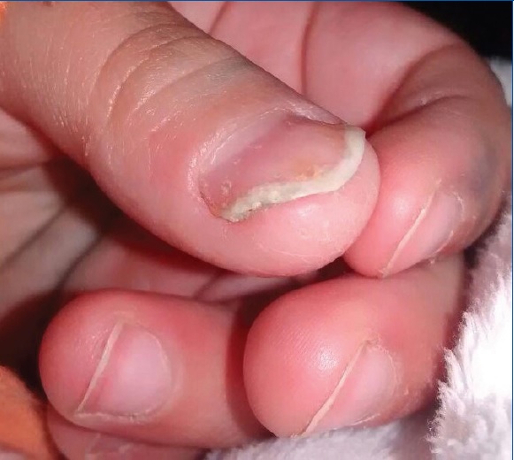 Paraqueratosis pustulosa tras tratamiento
