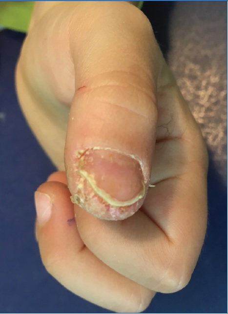 Paraqueratosis pustulosa al diagnóstico