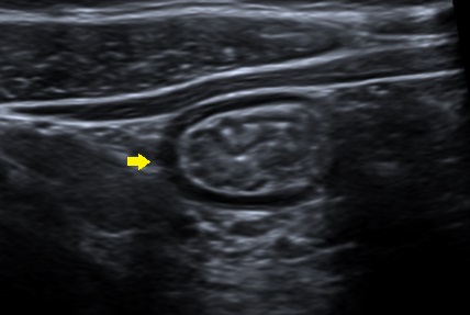 Figura 1. Ecografía abdominal. Se señala un asa intestinal de íleon terminal con un notable engrosamiento mucoso