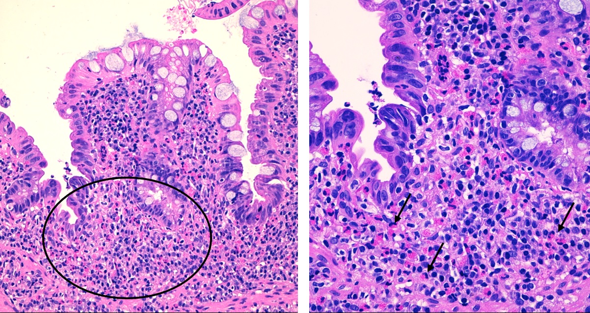 Figura 2. Mucosa colorrectal. Izquierda: leve distorsión arquitectural e incremento de la densidad celular en la lámina propia a expensas de un infiltrado inflamatorio crónico con predominio de eosinófilos (ver indicador). Derecha: a mayor aumento se observan células binucleadas con gránulos específicos citoplasmáticos que se tiñen de rojo brillante con eosina (flechas). Se contabilizan hasta 63 eosinófilos por campo de gran aumento