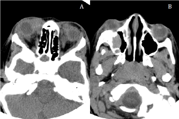 Figura 1. Cortes axiales de la tomograf&iacute;a computarizada donde se observan la afectaci&oacute;n periorbitaria bilateral, con infiltraci&oacute;n en el techo de ambas &oacute;rbitas y en el seno maxilar derecho