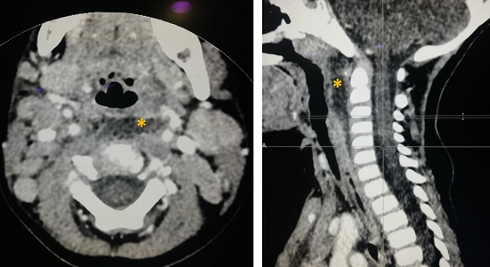 Figura 1. Lesión hipocaptante compatible con absceso en el espacio retrofaríngeo