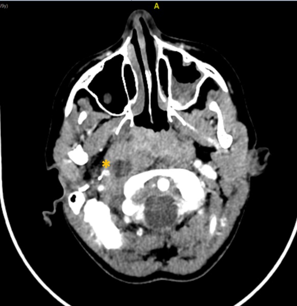 Figura 2. Lesión hipocaptante compatible con absceso en el espacio parafaríngeo derecho