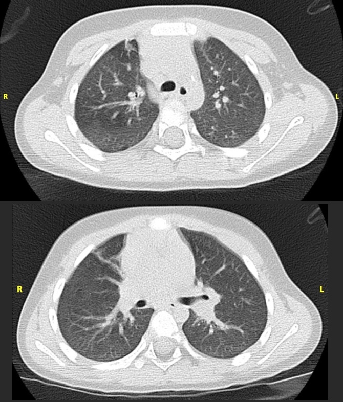 Figura 2. TC pulmonar en la que se evidencia atelectasia en el segmento medial del LM y en el segmento anterior del LSD, con discretas áreas de atrapamiento aéreo en el LSD, sin observarse bronquiectasias ni masas hiliares ni adenopatías mediastínicas o hiliares