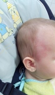 Figura 1. Síndrome de Frey: eritema en la zona temporal derecha coincidente con la ingesta de determinados alimentos