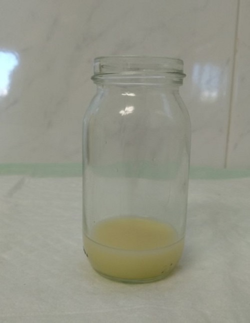 S&iacute;ndrome de rusty-pipe o de las tuber&iacute;as oxidadas: aspecto de la leche extra&iacute;da (d&iacute;a 6, con aspecto normal)